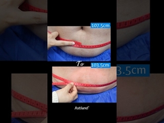 Παγώστε το λίπος, χάστε 4 εκατοστά σε 1 ώρα!