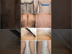 Αποτρίχωση με λέιζερ πριν και μετά