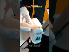 Δείτε την μη επεμβατική δύναμη ανύψωσης του HIFU