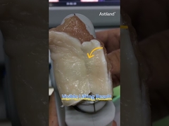 ας ελέγξουμε την άμεση ανυψωτική δράση του HIFU