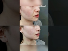 Έχετε Δοκιμάσει RF+ HIFU για Σύσφιξη Δέρματος; #Αντιγήρανση #ΑνόρθωσηΔέρματος #κλινικήομορφιάς #περιποίησηπροσώπου